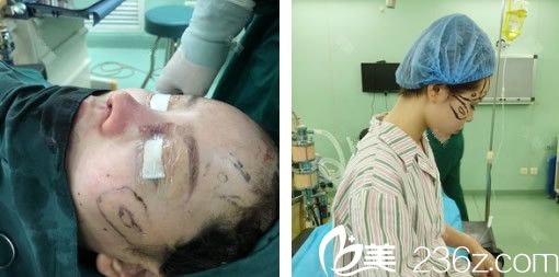 王清峰做鼻综合+面部自体脂肪填充手术过程中
