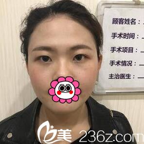 在<!--<i data=20240703-sp></i>-->整形医院做3D媚眼综合手术术前照 在<!--<i data=20240703-sp></i>-->整形医院做3D媚眼综合手术术前照