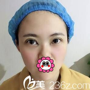 3D媚眼综合手术术后即刻效果 3D媚眼综合手术术后即刻效果