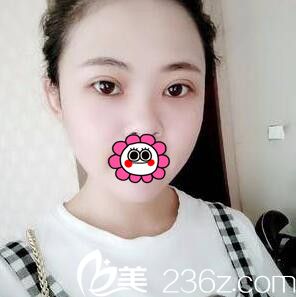 蒋新力做的3D媚眼综合手术术后半个月恢复效果 蒋新力做的3D媚眼综合手术术后半个月恢复效果