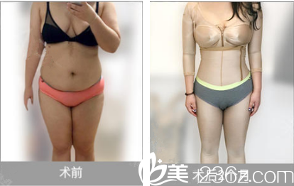 脂肪移植术案例 脂肪移植术案例