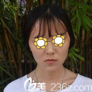 在韩国做下颌角术前照 在韩国做下颌角术前照