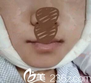 下颌角整形术后第二天效果 下颌角整形术后第二天效果
