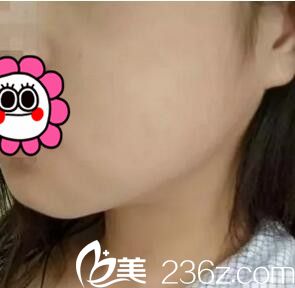 下颌角整形术后一周恢复程度 下颌角整形术后一周恢复程度