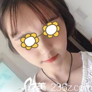 在韩国首尔整形外科做下颌角术后半个月效果 在韩国首尔整形外科做下颌角术后半个月效果