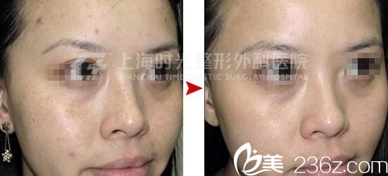 上海时光整形外科医院左雯君蜂巢皮秒祛斑祛痘真人案例