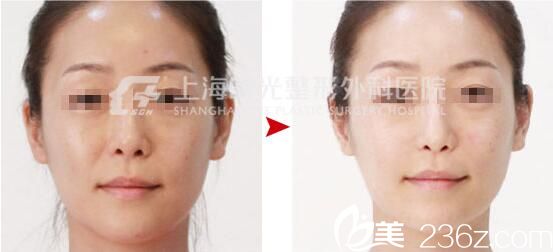 上海时光整形外科医院左雯君 美白祛黄真人案例