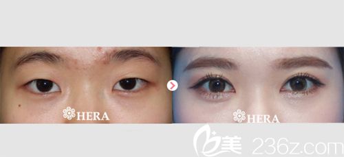 韩国赫拉(HERA)整形医院双眼皮案例对比图 韩国赫拉(HERA)整形医院双眼皮案例对比图