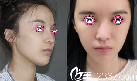 北京YK整形美容中心自体脂肪面部填充案例