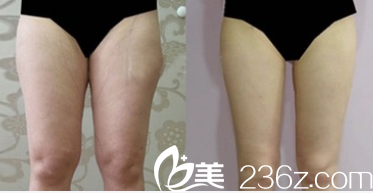 北京YK整形美容中心腿部吸脂案例