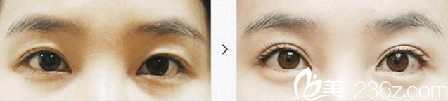 金鸿烈院长双眼皮消失修复案例 金鸿烈院长双眼皮消失修复案例