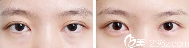 金鸿烈院长双眼皮不对称修复案例 金鸿烈院长双眼皮不对称修复案例