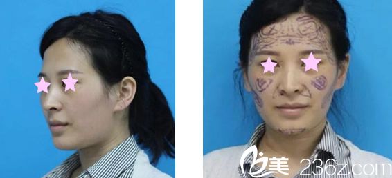 兰州韩美整形自体脂肪填充全脸前 兰州韩美整形自体脂肪填充全脸前