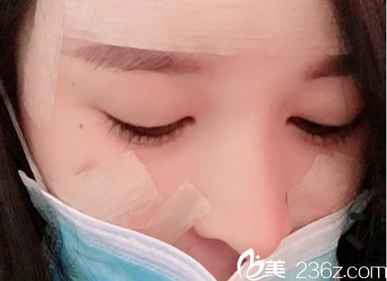 脂肪移植填充全脸天 脂肪移植填充全脸天