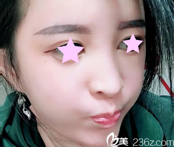 全脸脂肪填充15天后 全脸脂肪填充15天后