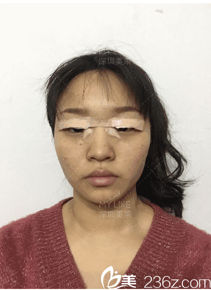 在深圳美莱做完双眼皮手术天