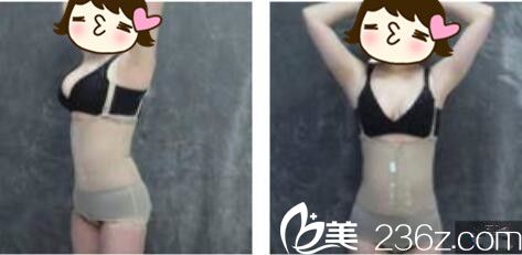 韩国DIMARE整形外科医院李夏荣腰腹吸脂真人案例术后第三天