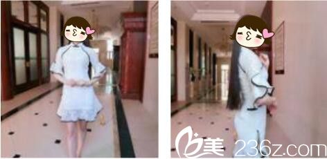 韩国DIMARE整形外科医院李夏荣腰腹吸脂真人术后十五天案例