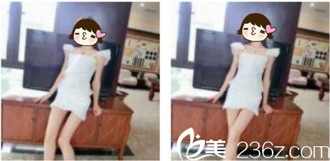 韩国DIMARE整形外科医院李夏荣腰腹吸脂真人案例术后一个月