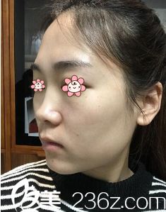 术前我的鼻子特别塌 术前我的鼻子特别塌