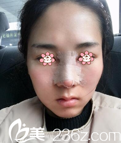 术后三天的样子 术后三天的样子