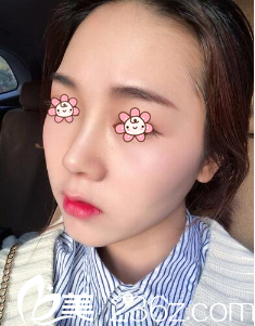 郑镐勋假体隆鼻术后11天 郑镐勋假体隆鼻术后11天