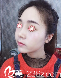 韩国I LOVE整形外科硅胶隆鼻术后18天 韩国I LOVE整形外科硅胶隆鼻术后18天