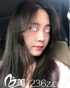 韩国I LOVE整形外科郑镐勋假体隆鼻术后一个月 韩国I LOVE整形外科郑镐勋假体隆鼻术后一个月