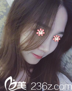 以下硅胶假体隆鼻+鼻综合案例来自韩国I LOVE整形外科郑镐勋院长。