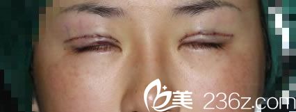 金华时光刚做完双眼皮修复图片