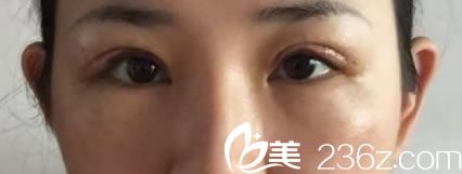 金华时光做双眼皮修复7天效果