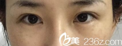 做完双眼皮修复手术30天照片