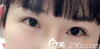 为了让大家变美路上少走弯路,现分享我在金华时光做双眼皮失败修复恢复日记