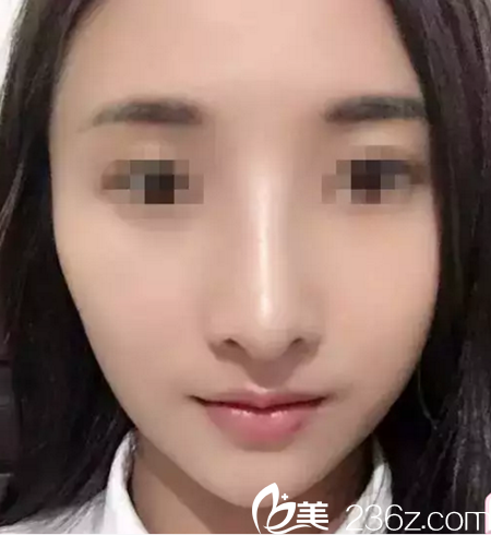 术后一周 术后一周