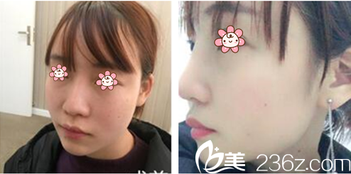 林秉州院长隆鼻修复案例