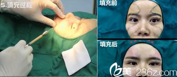 直播福州优医联合医美林潮医生的自体脂肪填充全脸手术过程及即刻效果