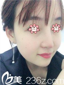 林秉州隆鼻失败修复术后一周 林秉州隆鼻失败修复术后一周