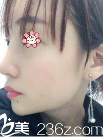 韩国I WANT整形外科林秉州鼻修复术后25天 韩国I WANT整形外科林秉州鼻修复术后25天