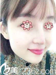 韩国I WANT整形外科鼻修复术后半个月 韩国I WANT整形外科鼻修复术后半个月