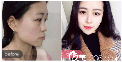 深圳富华整形医院做的隆鼻案例图 深圳富华整形医院做的隆鼻案例图