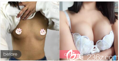 深圳富华曹孟君做的假体隆胸案例 深圳富华曹孟君做的假体隆胸案例