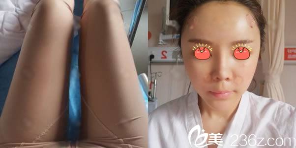 刚做完大腿抽脂和脂肪填充效果