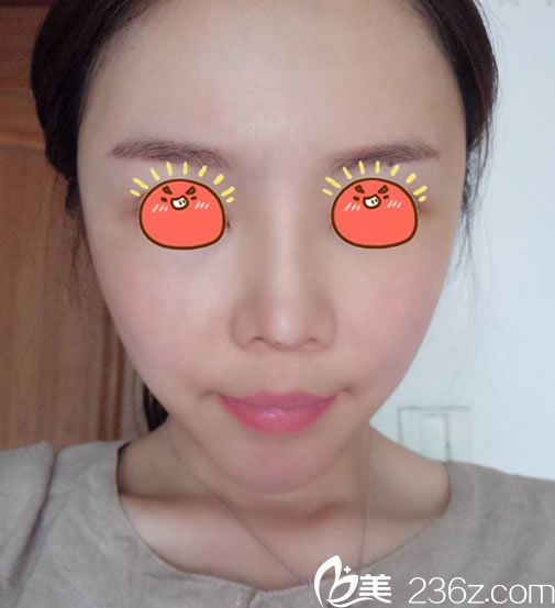 找李文鹏医生做面填3天后