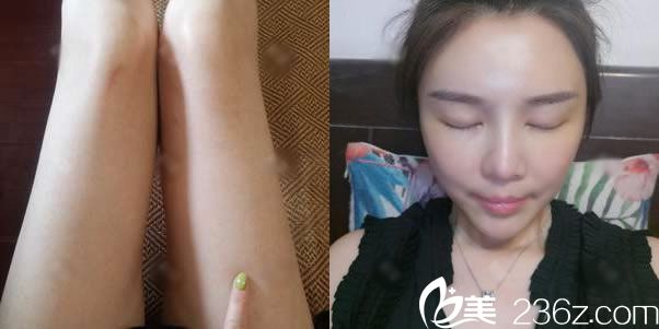 找连天美李文鹏抽脂8天恢复照