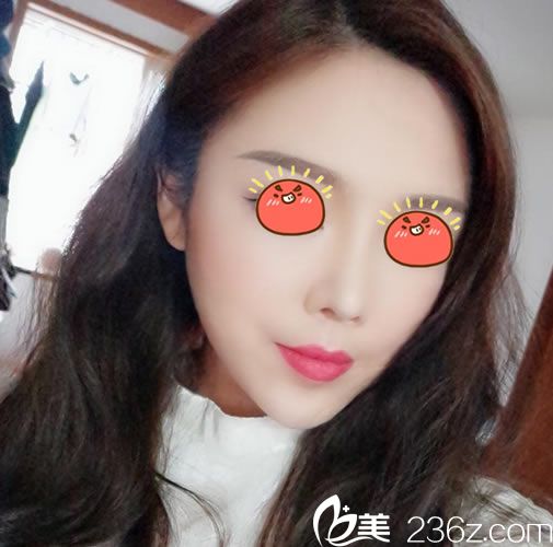 杭州连天美李文鹏脂肪填充30天后