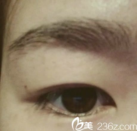 去宁波美仁整形做双眼皮前 去宁波美仁整形做双眼皮前