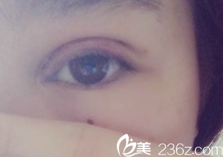 在宁波美仁整形做双眼皮3天后 在宁波美仁整形做双眼皮3天后