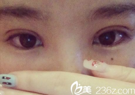 宁波美仁整形双眼皮<span style= 宁波美仁整形双眼皮<span style=