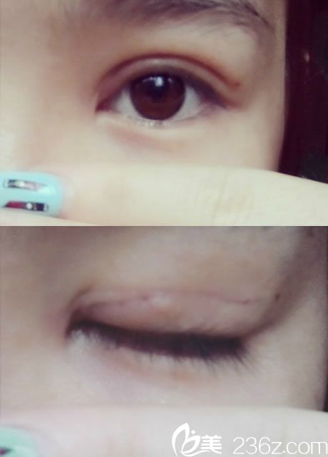 双眼皮拆线当天睁眼和闭眼图片 双眼皮拆线当天睁眼和闭眼图片