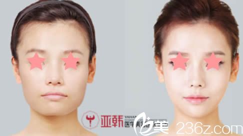 长沙亚韩整形医院赵贵庆面部轮廓手术案例图 长沙亚韩整形医院赵贵庆面部轮廓手术案例图